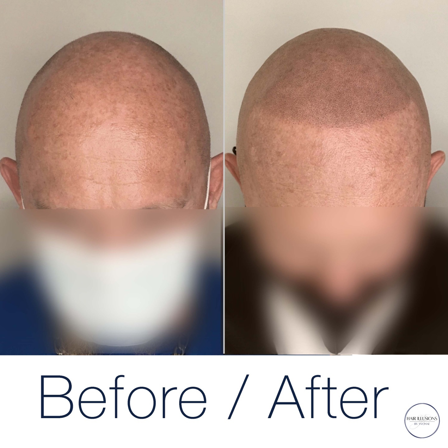 If the look of a hairless scalp leaves you feeling self-conscious and dissatisfied, know that there is a virtually pain-free solution availa