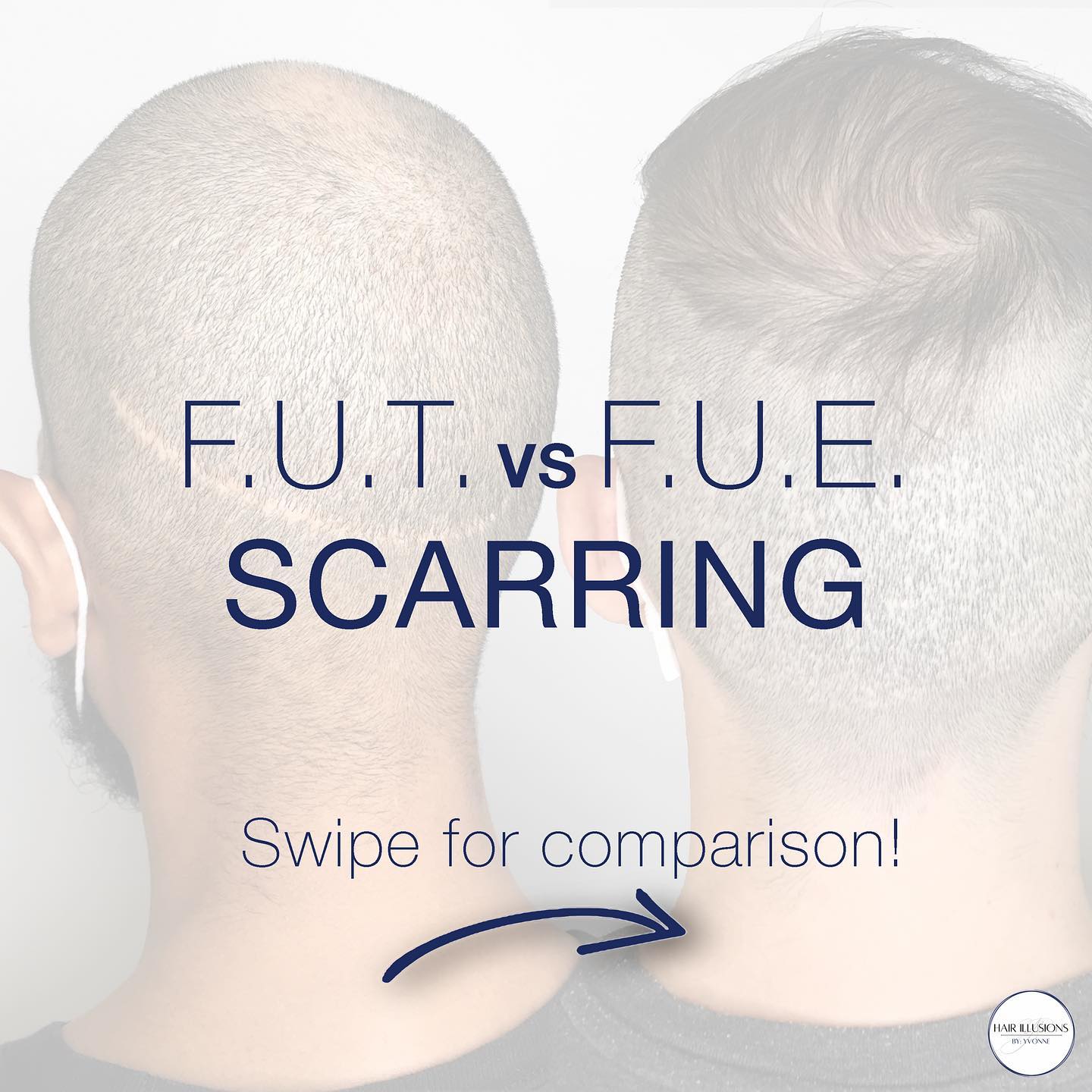 Let's talk hair transplants!
F.U.E and F.U.T are two different hair transplant methods, both which leave behind scarring and patchy areas on