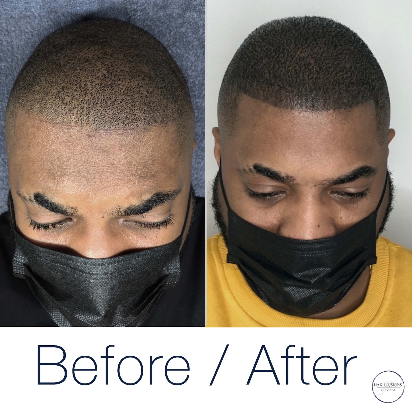 This client decided to shave his hair to achieve the best overall result, but this left him with a weak hairline. In order to get back that 