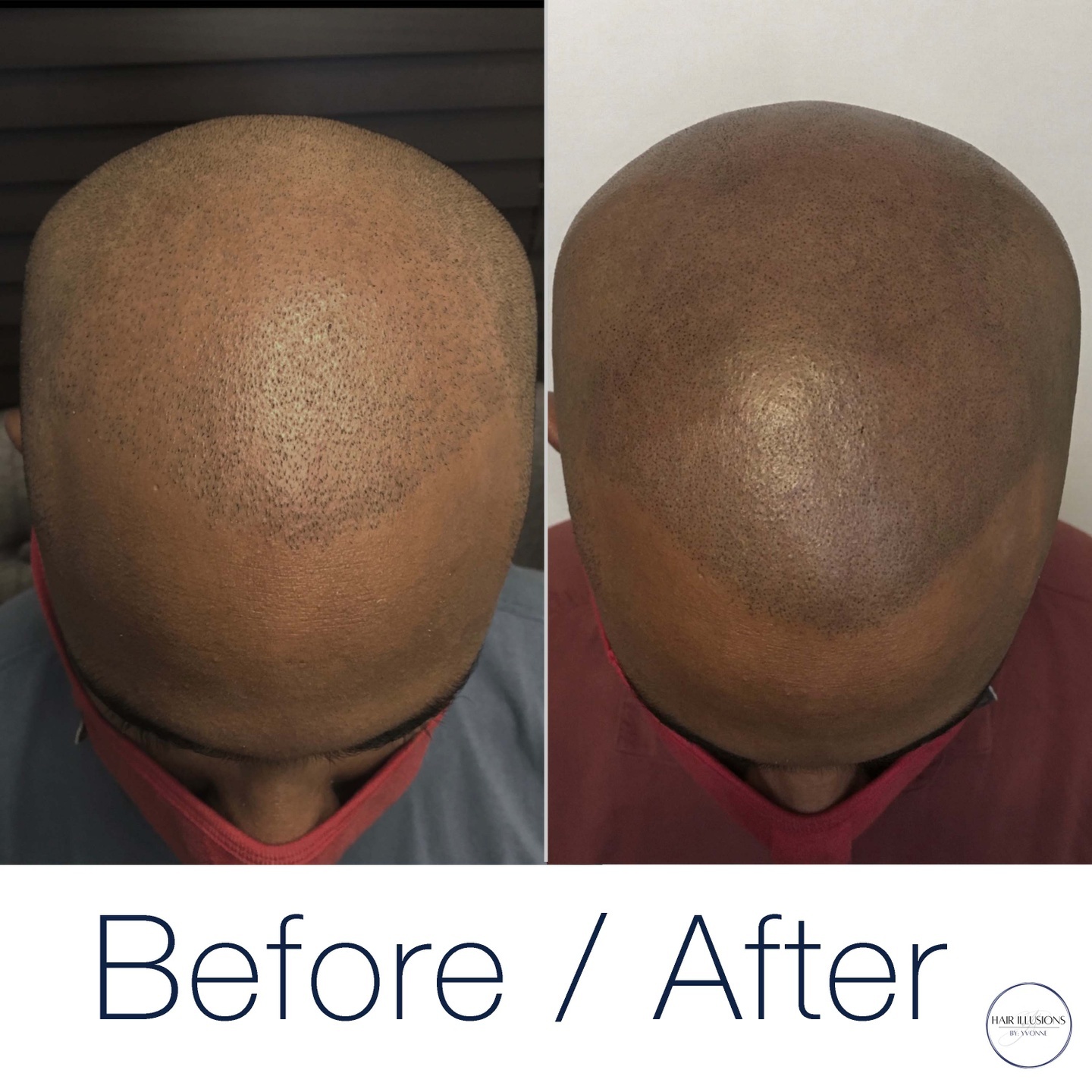 This client was more than pleased with his application process and final result. I was able to subtly follow along with his natural hairline