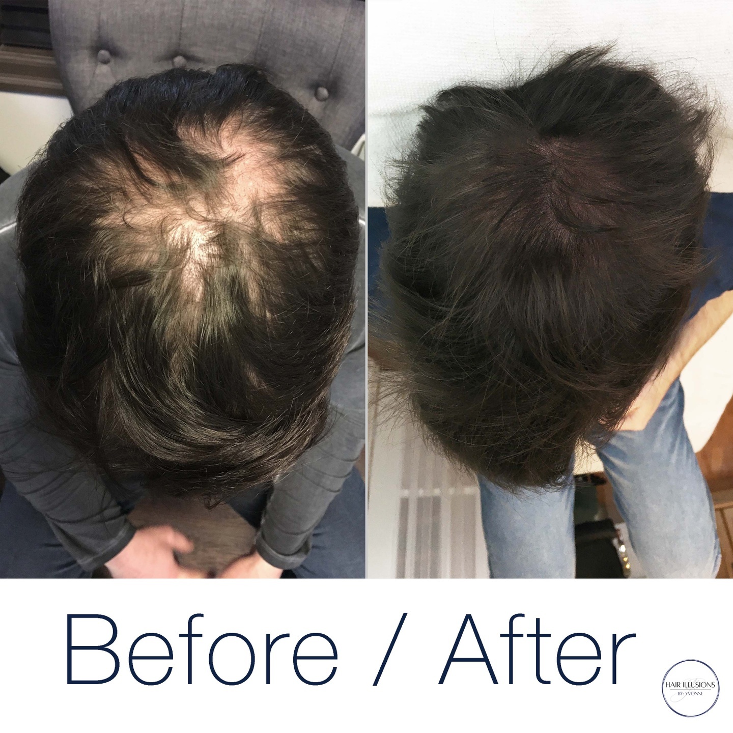 You would never know that this client has the same amount of hair on his head in both photos. What a difference tiny micro dots can make! If