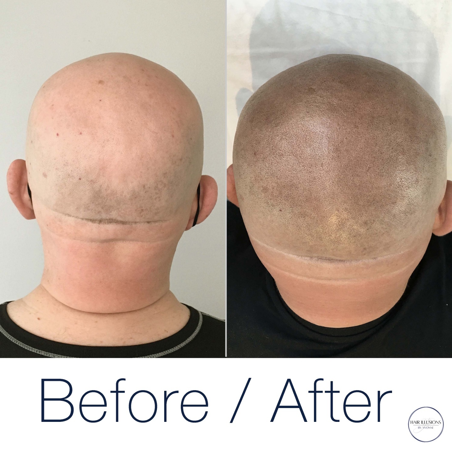 Struggling with hairloss and finally ready to revamp your look? I'd love to play a part in making that happen.