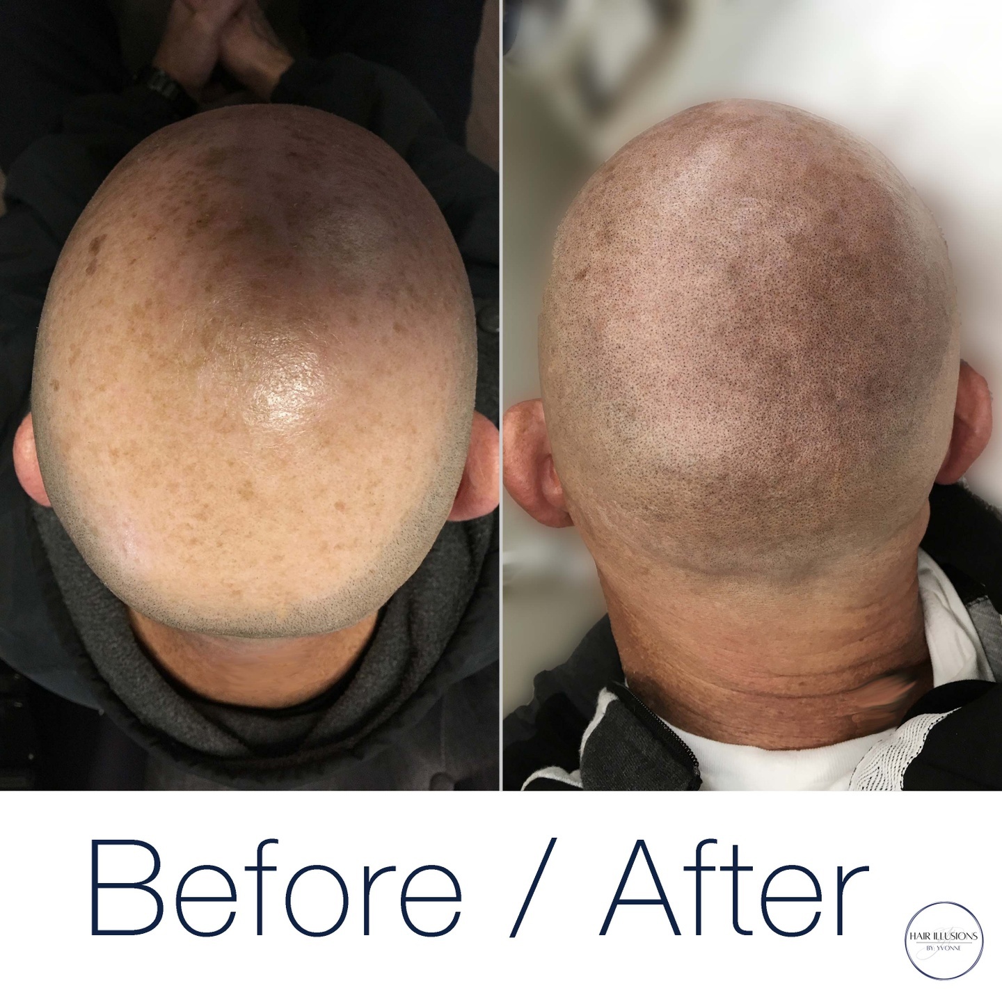 As well as adding density, SMP is a great way to cover up discolouration on the skin caused by sun exposure, etc. Take a look at these resul