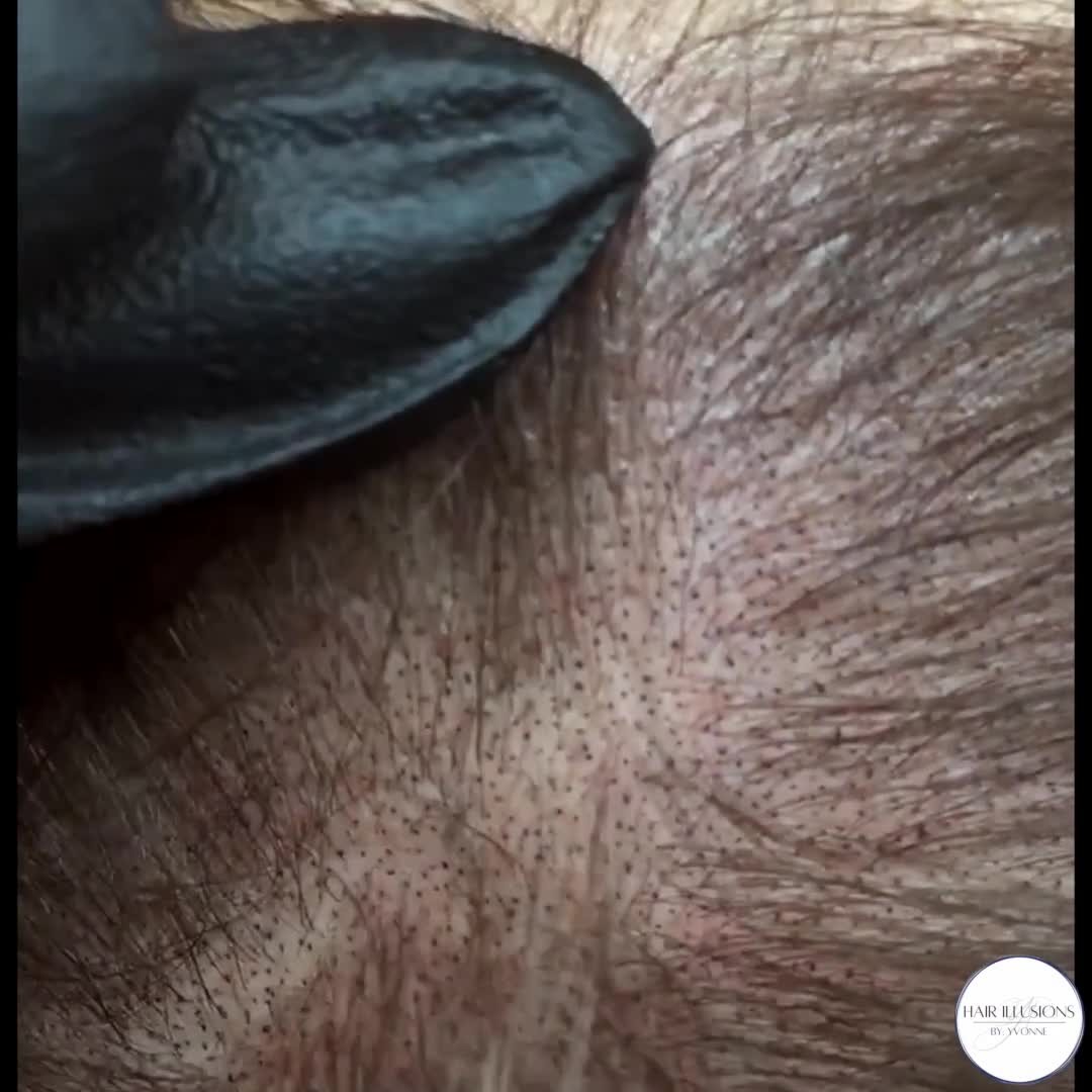I love to showcase what SMP can do to scalps with long pre-existing hairs. These results after just one session look very natural, and the l