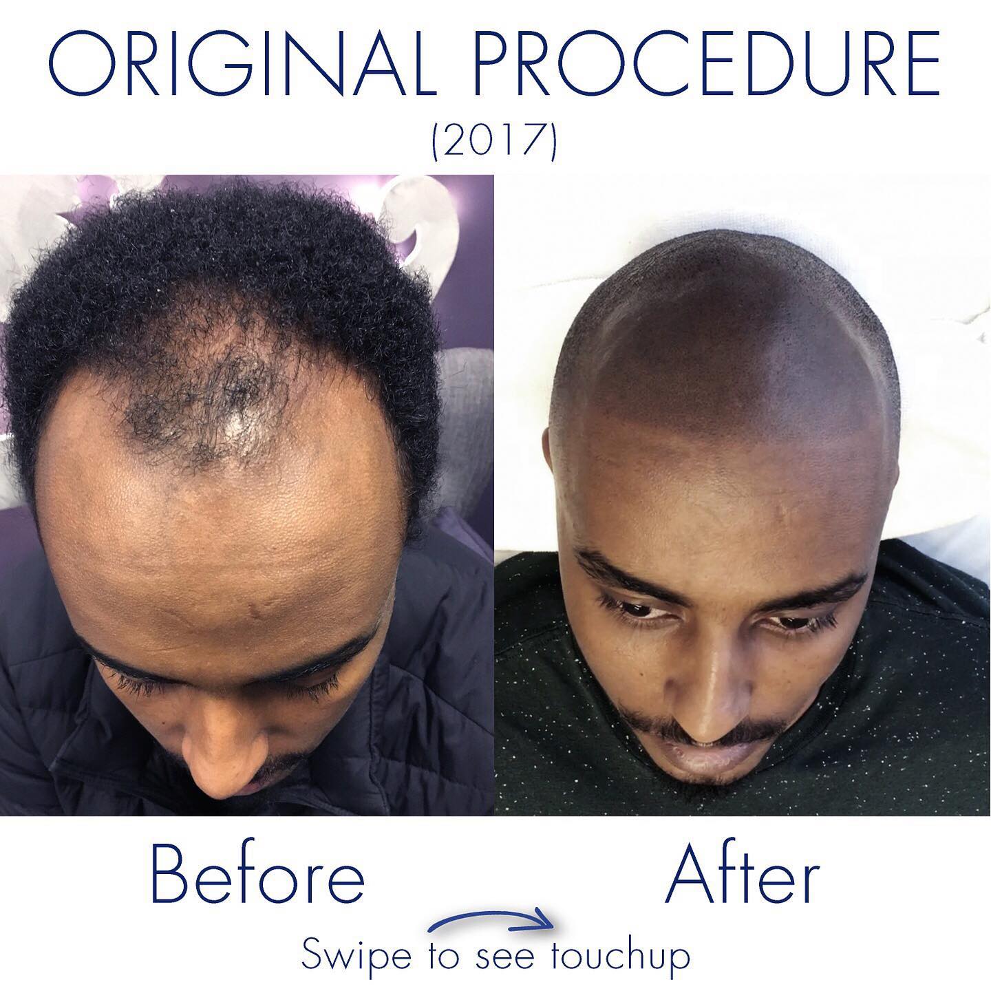 Although SMP can be performed alongside longer, visible hairs, it's best to keep existing hair short in order to achieve the most realistic,