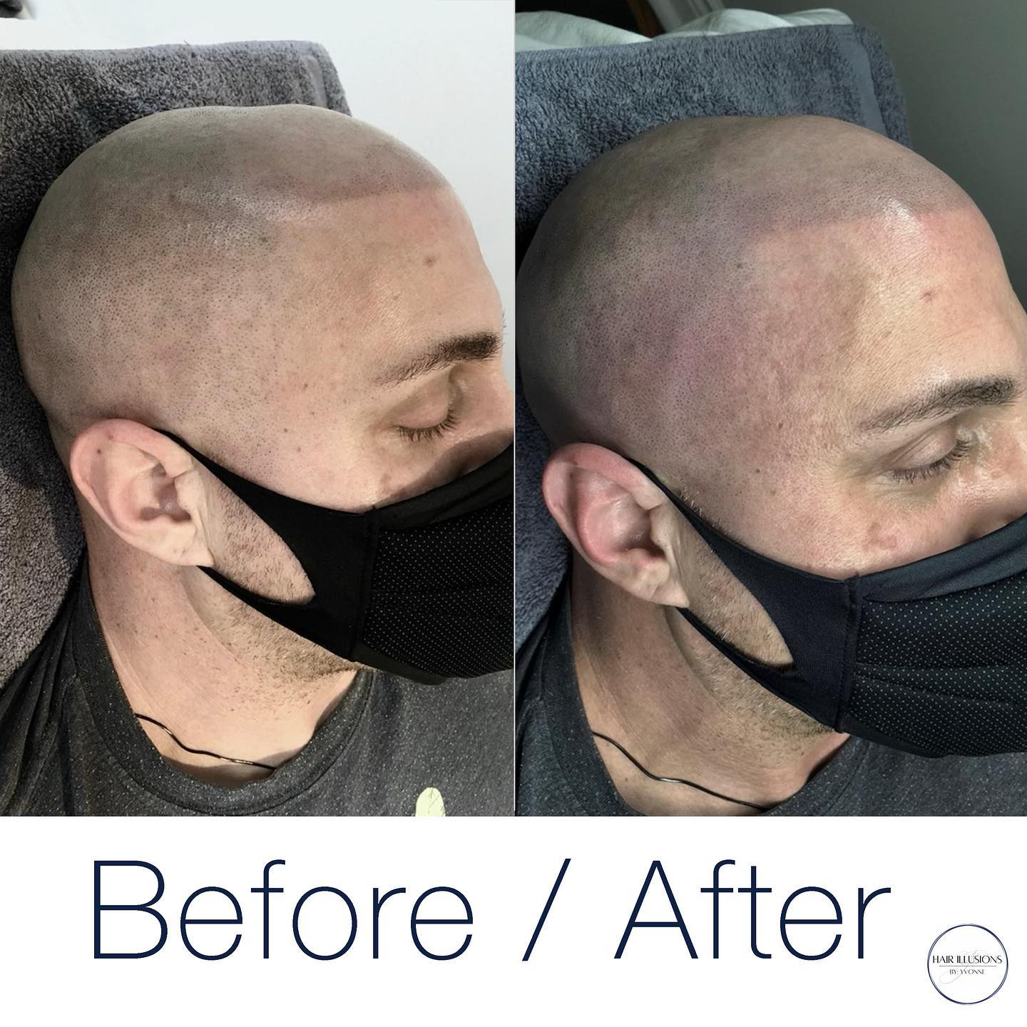 Since his SMP procedure, this client continued to lose hair. To combat this, we added more SMP follicles to blend in with his natural follic