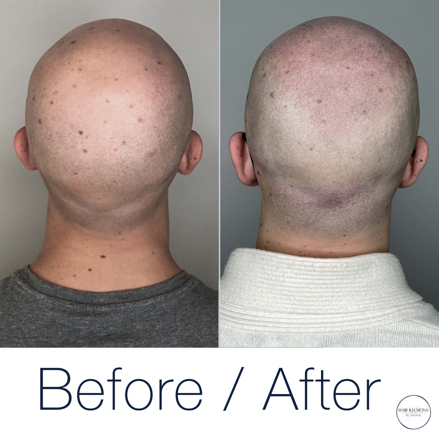 SMP can make dark spots, moles and sun damage less visible, resulting in a younger, healthier looking scalp.
